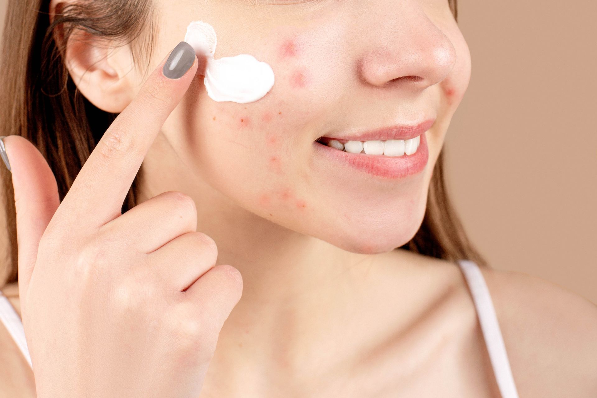 Jak wyleczyć trądzik?